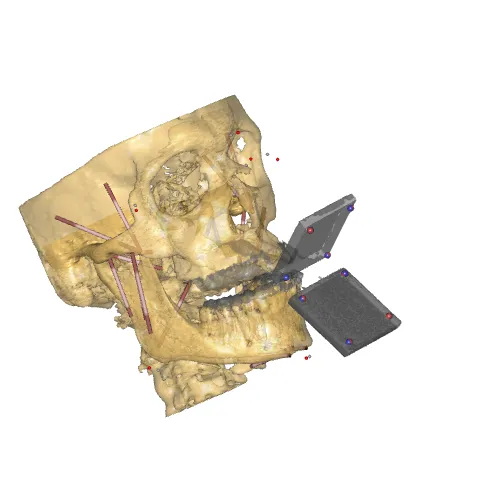 The Aalborg Mandible model